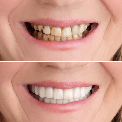 PerfectSmile | 1 + 1 Gratis - Bereik Het Ideale Gebit